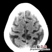 脑萎缩会出现什么症状