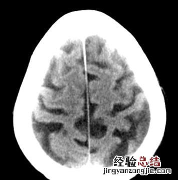 脑萎缩会出现什么症状