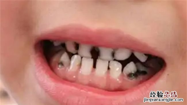 牙烂到什么程度要根管治疗