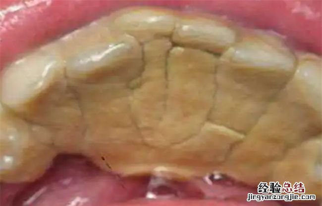 医生不建议清理牙结石有什么说法