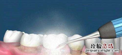 医生不建议清理牙结石有什么说法