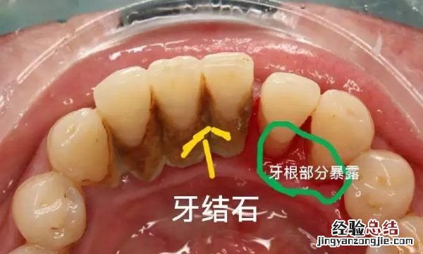 医生不建议清理牙结石有什么说法