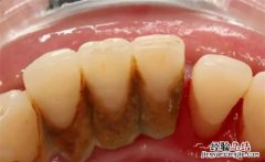 医生不建议清理牙结石有什么说法