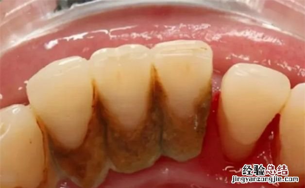 医生不建议清理牙结石有什么说法