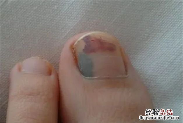 女朋友很漂亮但是有灰指甲怎么办