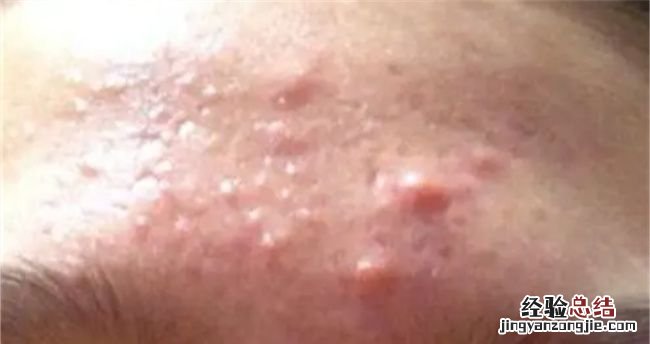 额头长痘痘是什么原因怎么调理