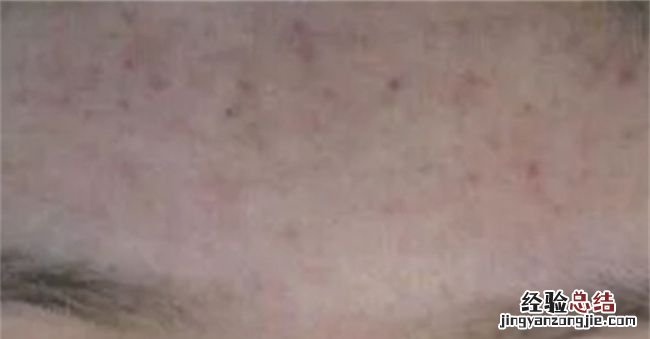 额头长痘痘是什么原因怎么调理