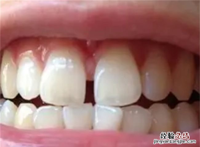 牙缝会不会因拔智齿变大