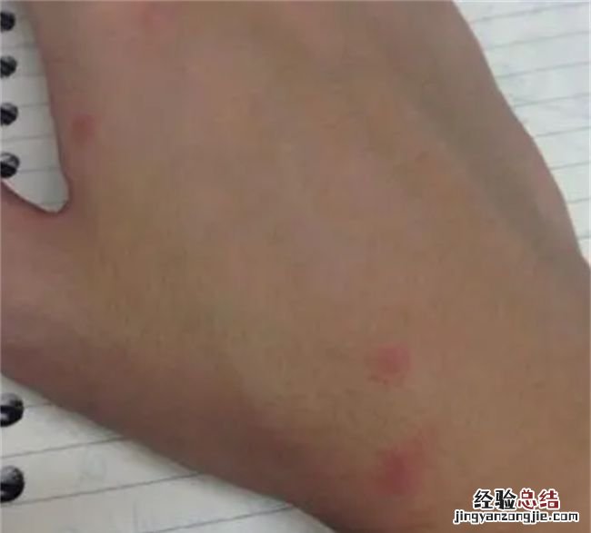 被蚊子咬了会不会留疤，小宝宝脸上被蚊子咬了 一直有疤痕怎么办