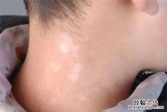 白斑是怎么形成的,突然长出白斑是什么原因