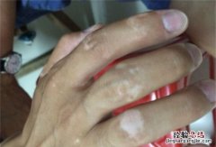 白斑是怎么形成的，突然长出白斑是什么原因