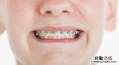 为什么建议不要随便整牙