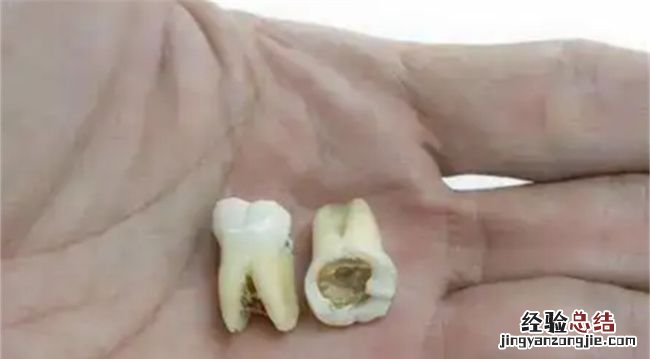 牙齿蛀空了一定要拔么,牙齿坏了一半里面都空了可以拔掉