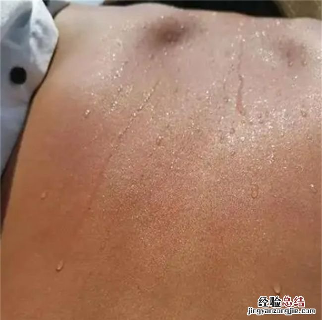 三伏天晒背后的排病反应，三伏天晒后背有什么好处
