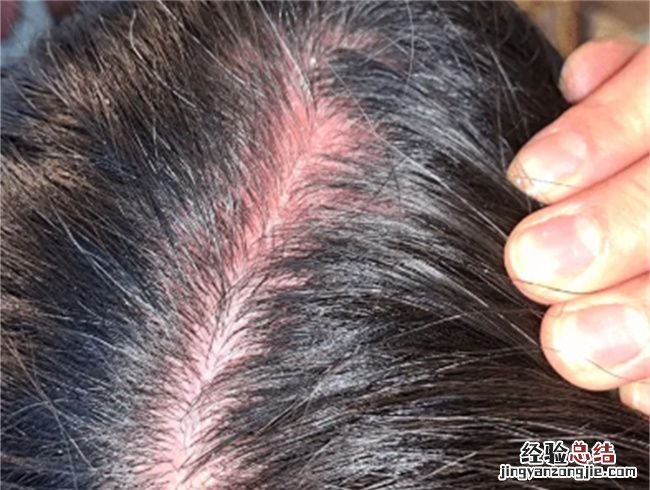 爽身粉擦头发有危害,爽身粉去头油有哪些害处呢