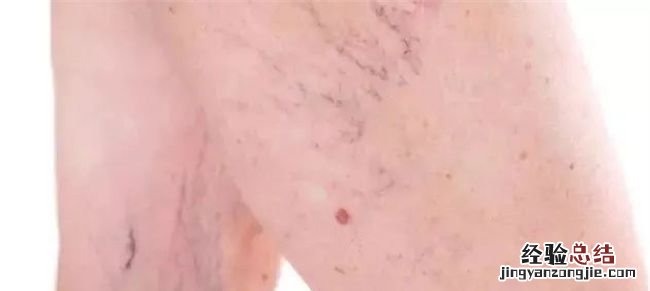 这些红点的出现需要立即就医,身上出现很多小红点是怎么回事
