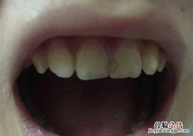 牙齿凹槽上面有黑色是蛀牙