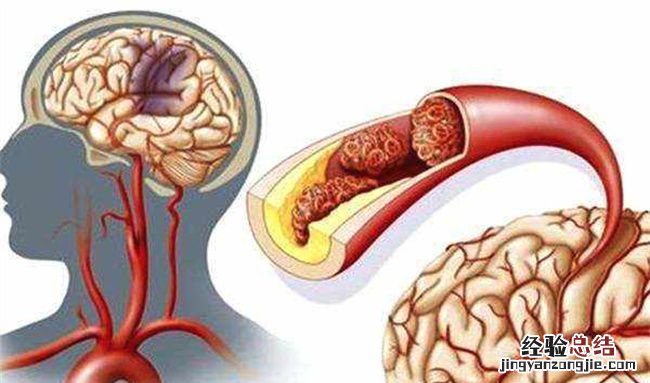 心脑血管疾病的原因，导致心脑血管疾病的危险因素有哪些
