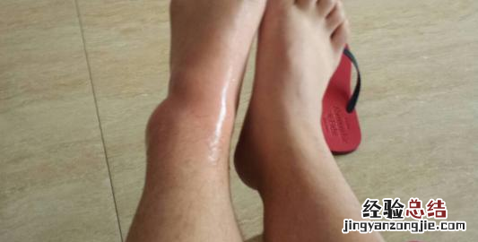 打球崴脚了怎么处理,打篮球脚崴伤了怎么缓解