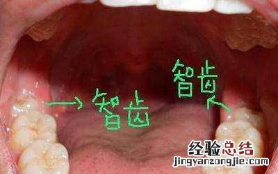 智齿不拔有什么影响没，智牙留着不拔可以会不会有什么影响