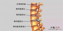 腰间盘突出的治疗方法，腰间盘突出症不花钱、最简单的治疗方式