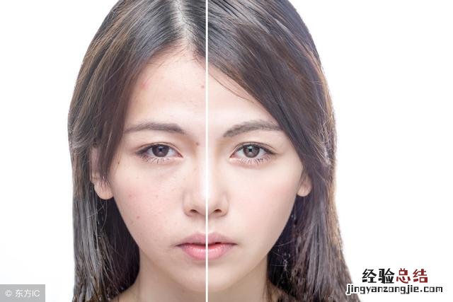 额头痘痘最简单的去除方法 额头上长痘怎样简便消除