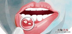 简单治疗口腔溃疡的8个妙方 口腔溃疡反复发作怎么根治