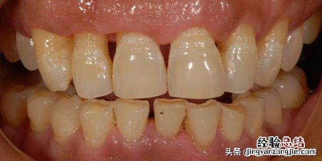 牙缝越来越大是什么原因引起的 牙齿之间的缝越来越宽怎么办