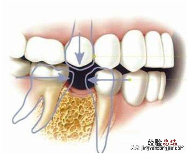 牙缝越来越大是什么原因引起的 牙齿之间的缝越来越宽怎么办