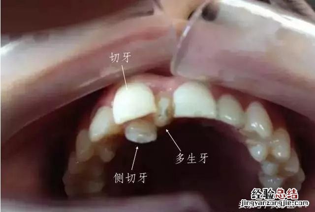 门牙牙缝越来越宽的补救办法 门牙缝隙慢慢变大怎么办