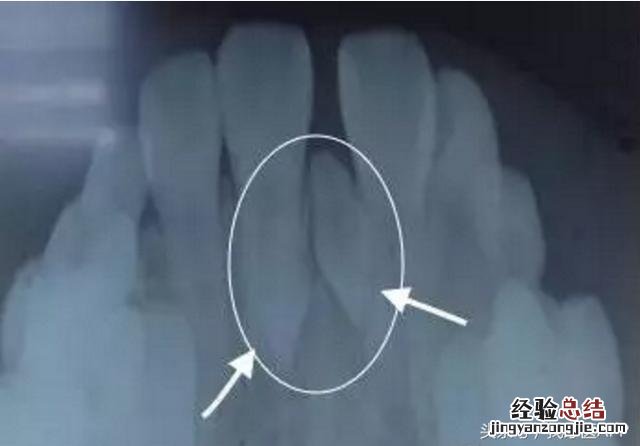 门牙牙缝越来越宽的补救办法 门牙缝隙慢慢变大怎么办