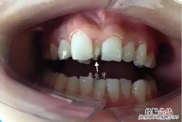 门牙牙缝越来越宽的补救办法 门牙缝隙慢慢变大怎么办