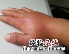 被蜜蜂蛰了如何快速的处理 手被蜂子蛰了怎么消肿止痒