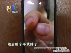 蝎子蜇伤人快速止疼方法 蝎子蛰了怎么办