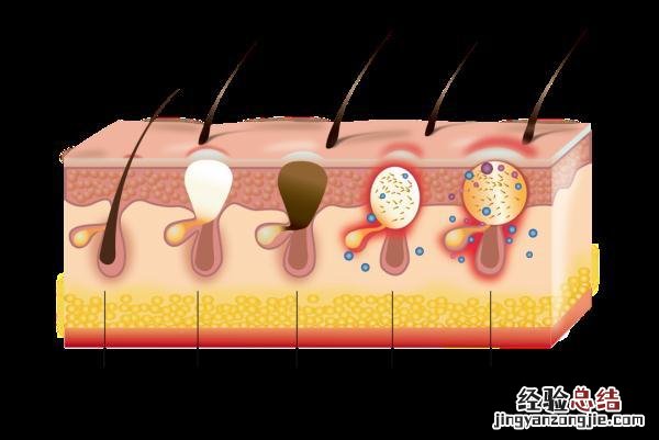 痤疮的认知误区与调护 痤疮怎么引起的