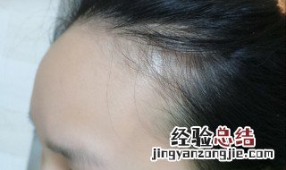 女生额头高怎么办 女生额头高解决方法