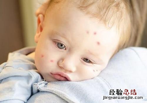 宝宝被蚊子咬可以抹牙膏吗 宝宝被蚊子咬可以涂牙膏吗