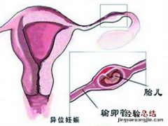 宫角妊娠是什么原因引起的 宫外孕是怎么引起的