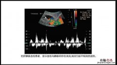 见血流信号是什么意思