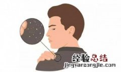 最简单快速去除头皮屑 最简单快速去除头皮屑方法是什么