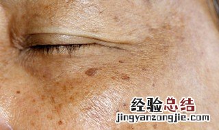 老年斑是怎么形成的 老年斑是怎么形成的怎么预防和治疗