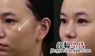 印第安纹怎么才能消除 印第安纹如何才能消除