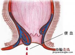 产后便血怎么回事 产后便血是怎么回事