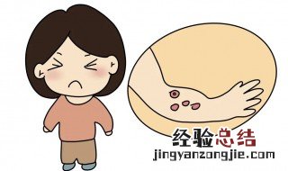 烫出泡了怎么处理方法 烫伤后起水泡处理方法