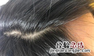 头皮屑怎么形成的? 头皮屑怎么形成的