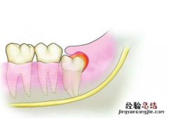 怀孕之前要不要拔智齿 怀孕前到底要不要拔了智齿