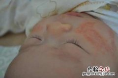 宝宝湿疹结痂了怎么办 婴儿湿疹结痂怎么处理