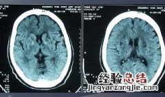 多发腔隙性脑梗塞是什么意思 多发腔隙性脑梗塞的意思