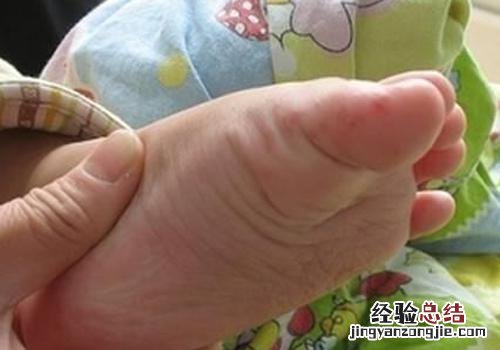 小孩手足口病可以治好吗 小孩手足口病能治好吗