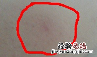 蚊子咬的包怎么解决 蚊子咬的包解决方法